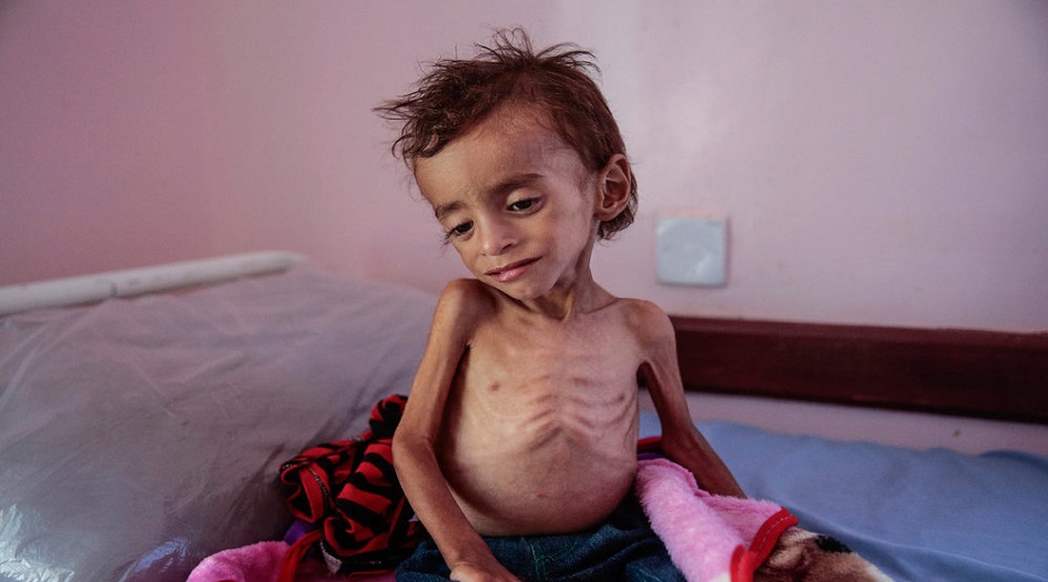 سوء التغذية الحاد يهدد نصف أطفال اليمن