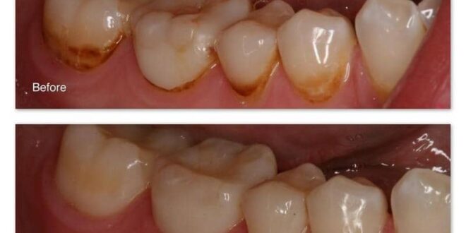 كيف تتخلص من البقع البنية على الأسنان ؟
