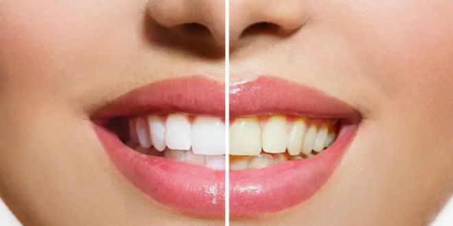  حيل مدهشة لحماية الأسنان من الاصفرار
