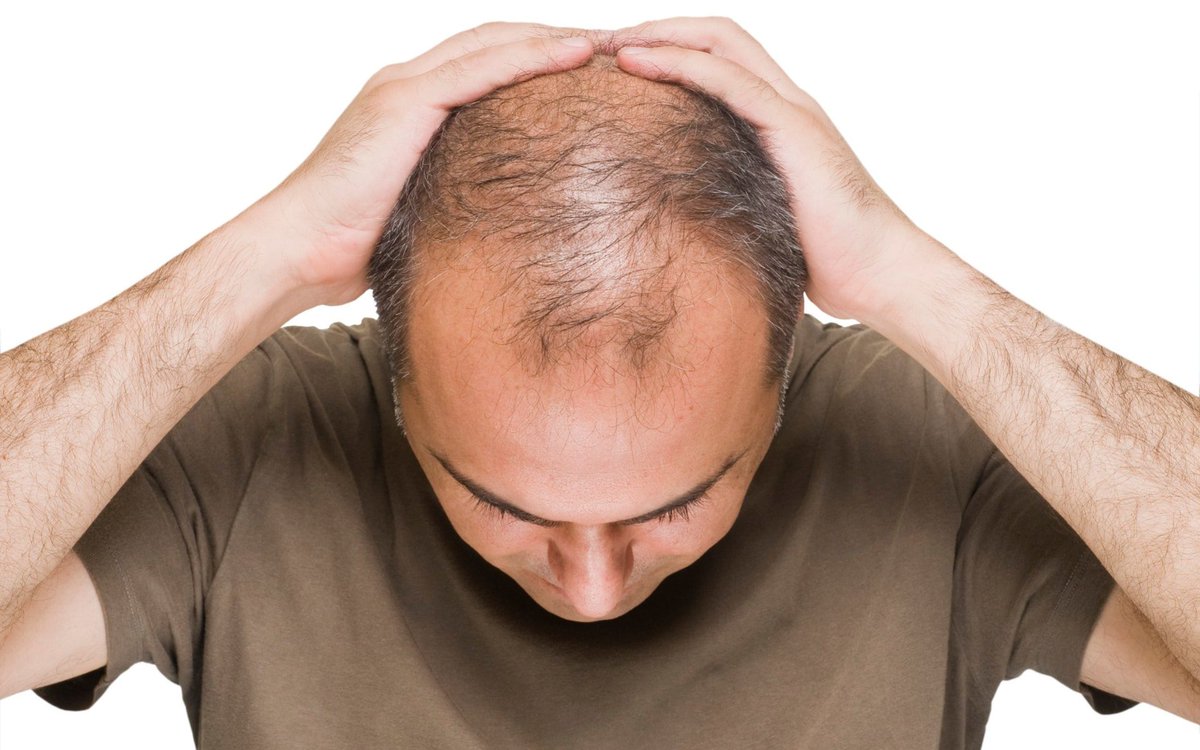درمانی آسان و کم هزینه برای ریزش مو
