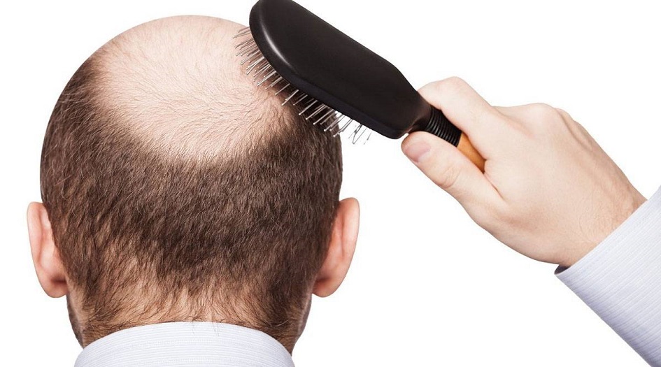 عوامل خطيرة وأقل شهرة لتساقط الشعر