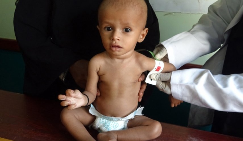 «الصحة العالمية»: 75% من أطفال اليمن يعانون سوء التغذية المزمن