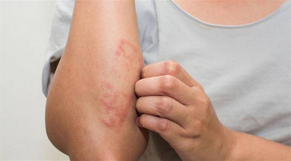 أعراض تظهر على الجلد نتيجة الإصابة بكورونا