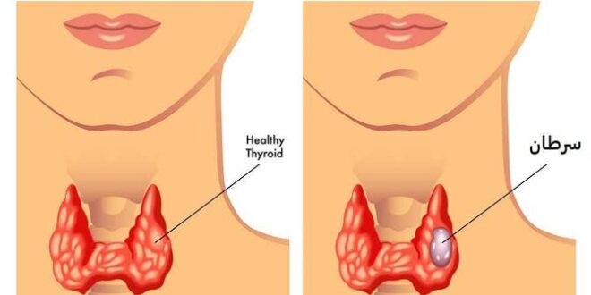 أعراض تدل على الإصابة بسرطان الغدة الدرقية Thyroid cancer
