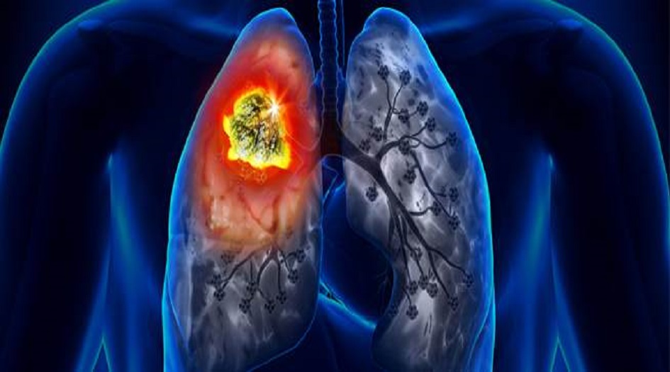 “طبيب روسي” يحدد الفئات الأكثر عرضة للإصابة بسرطان الرئة