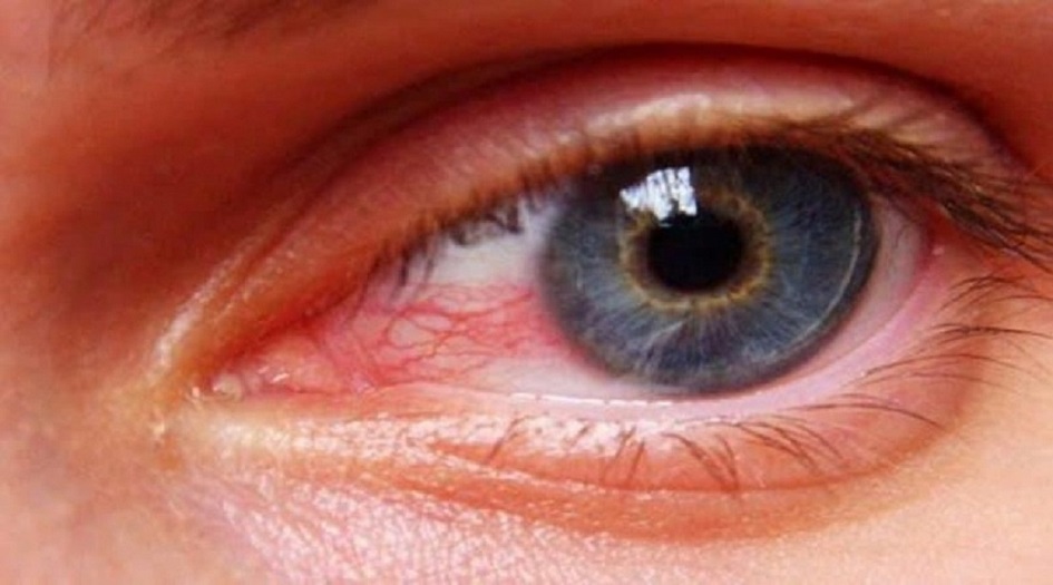 علامات في العينين تدل على الإصابة بالسكري