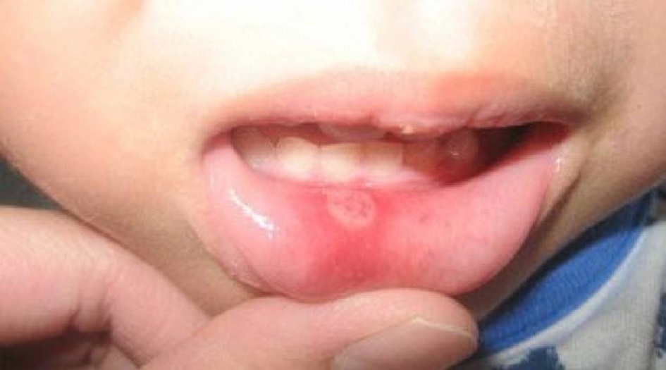 علامة تظهر داخل الفم تدل على الإصابة بجدري القردة