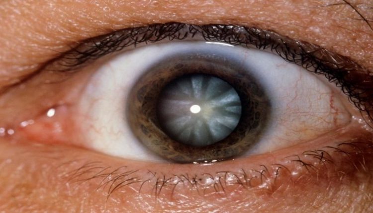 ما هي العلامات التي تدل على اصابتك بسرطان العين؟
